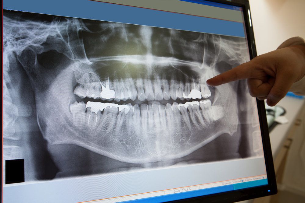 A digital X-ray image shows a persons's jaw and teeth with a finger pointing to a specific tooth.
